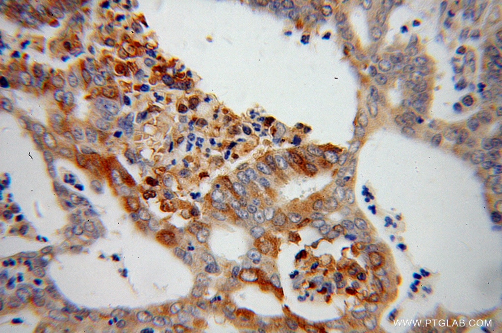Immunohistochemistry (IHC) staining of human endometrial cancer tissue using PARN Polyclonal antibody (13799-1-AP)