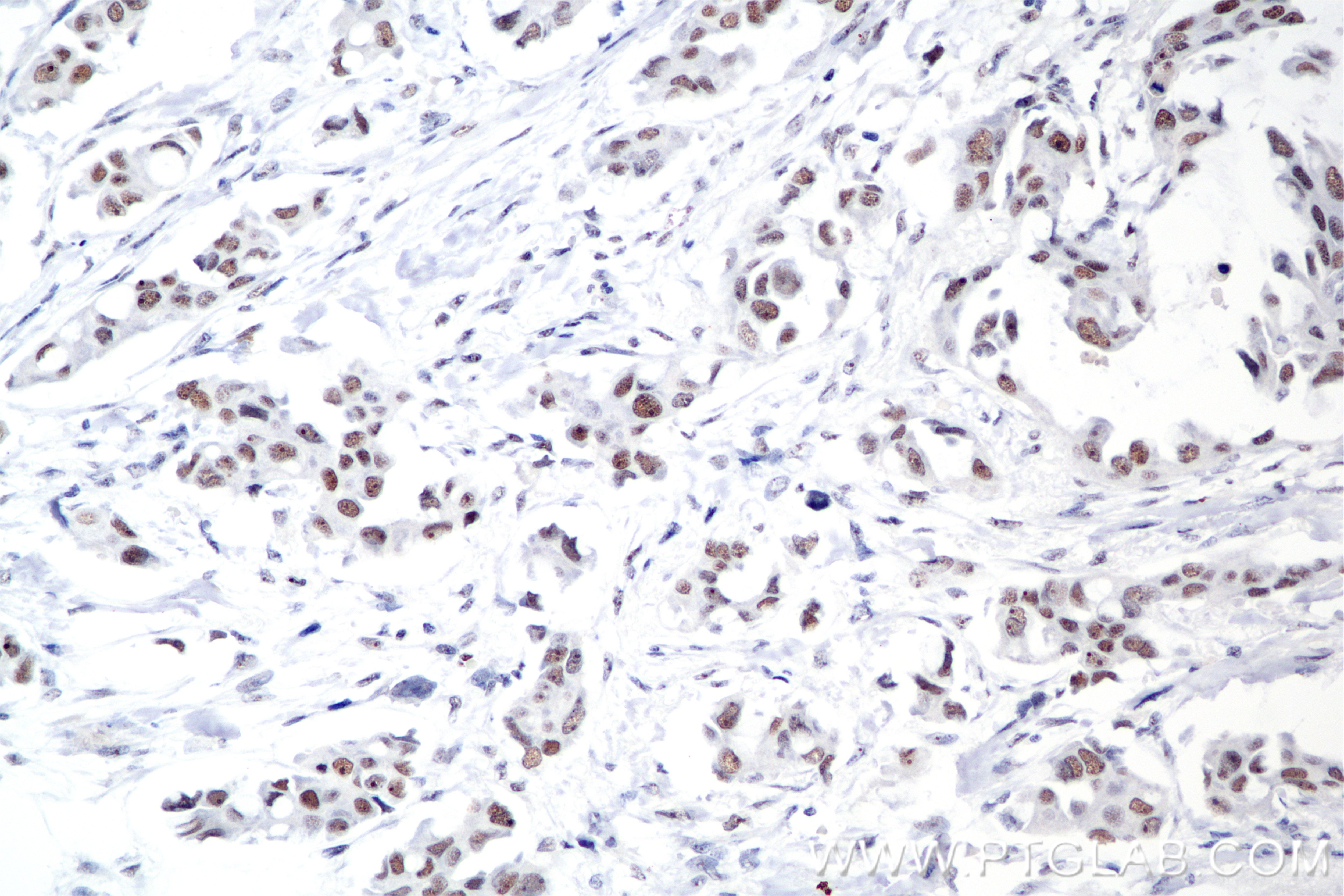 Immunohistochemical analysis of paraffin-embedded Human Breast Cancer(Her2+;ER-;PR-) slide using 85408-5-RR (PARN antibody) at dilution of 1:1000 (under 20x lens). Heat mediated antigen retrieval with Tris-EDTA buffer (pH 9.0). Immunohistochemistry (IHC) staining of Human Breast Cancer(Her2+;ER-;PR-) using PARN Recombinant monoclonal antibody (85408-5-RR)