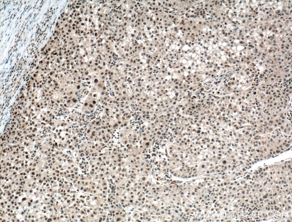 IHC staining of human liver cancer using 13371-1-AP