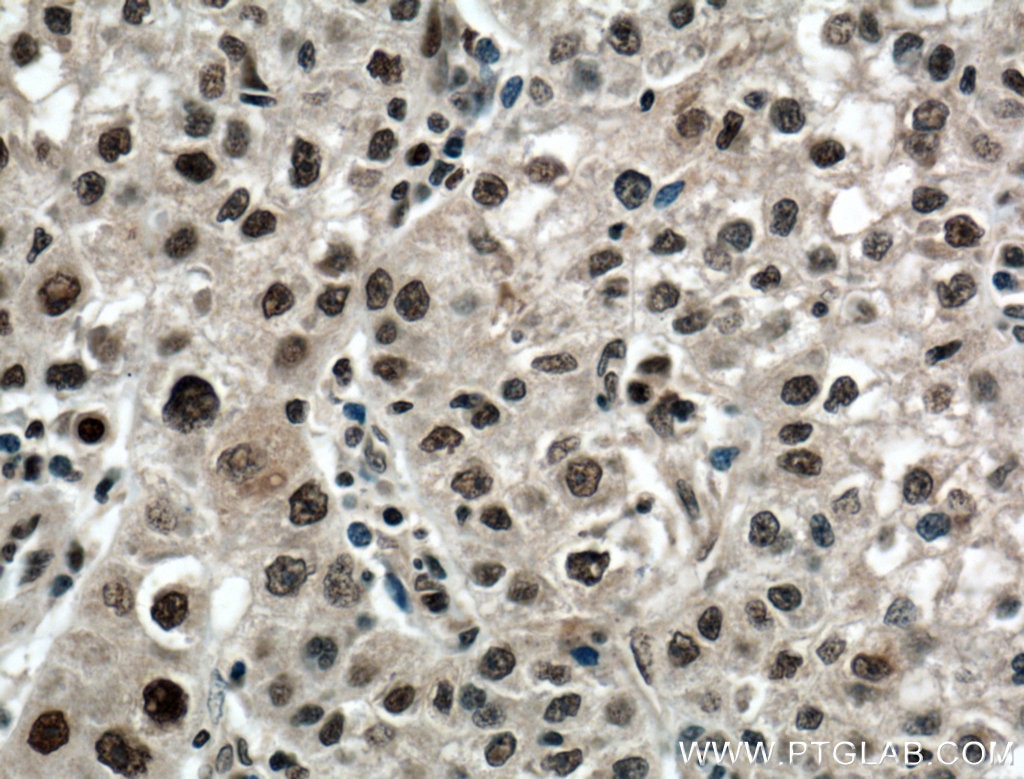 Immunohistochemistry (IHC) staining of human liver cancer tissue using PARP1 Polyclonal antibody (13371-1-AP)