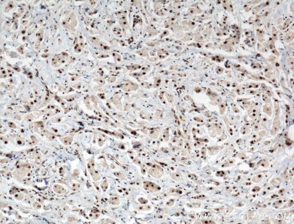 Immunohistochemistry (IHC) staining of human breast cancer tissue using PARP1 Polyclonal antibody (13371-1-AP)