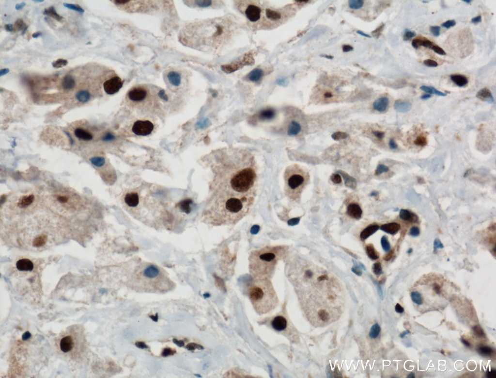 Immunohistochemistry (IHC) staining of human breast cancer tissue using PARP1 Polyclonal antibody (13371-1-AP)