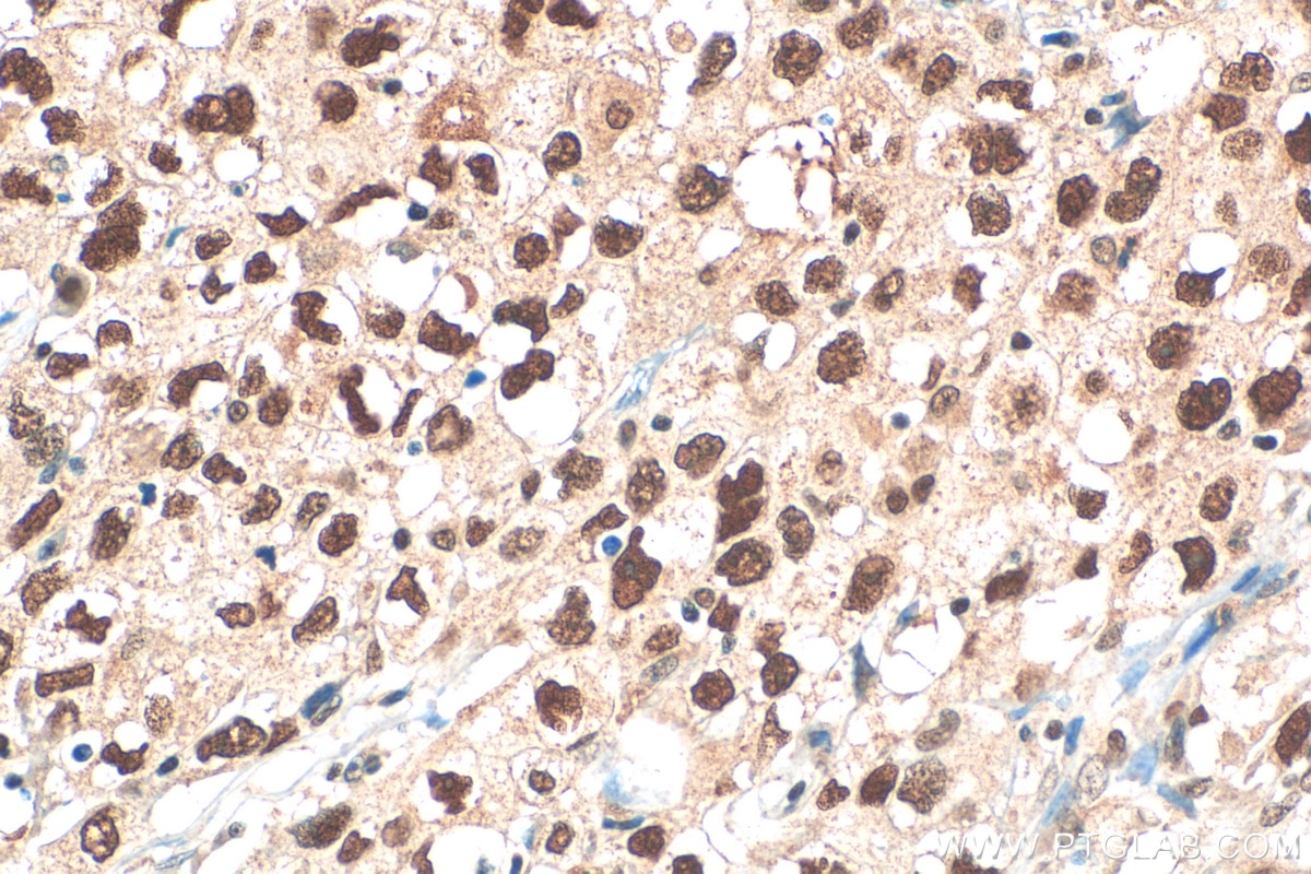 Immunohistochemistry (IHC) staining of human lung cancer tissue using PARP1 Polyclonal antibody (13371-1-AP)