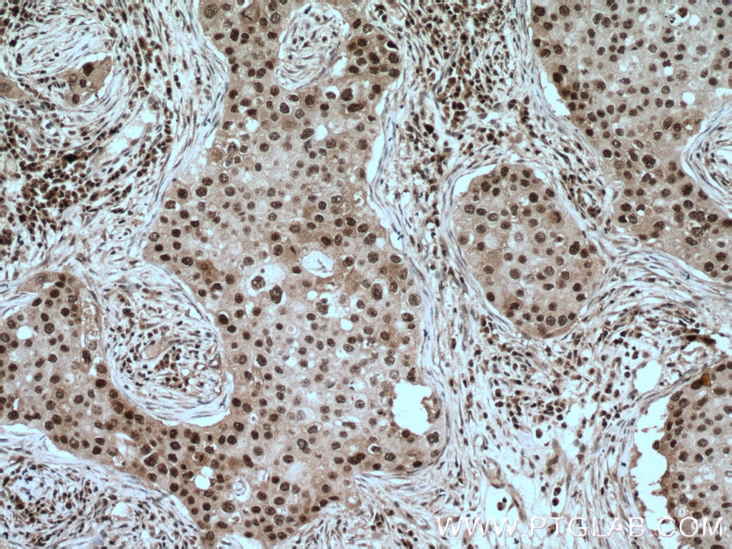 Immunohistochemistry (IHC) staining of human breast cancer tissue using PARP1 Polyclonal antibody (22999-1-AP)