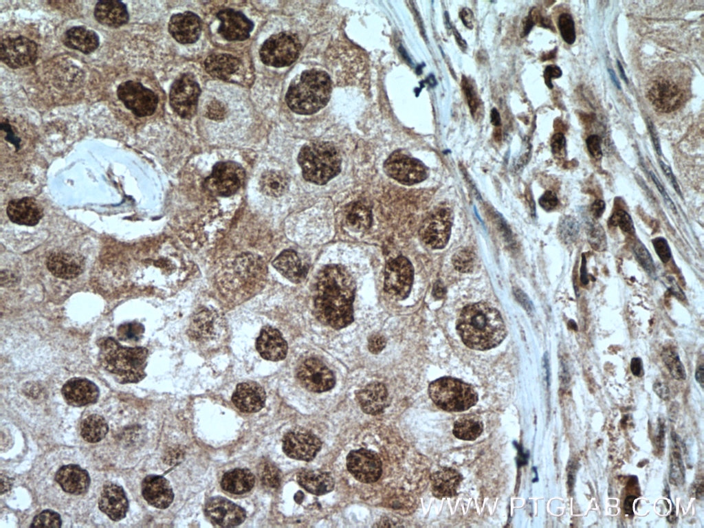 Immunohistochemistry (IHC) staining of human breast cancer tissue using PARP1 Polyclonal antibody (22999-1-AP)