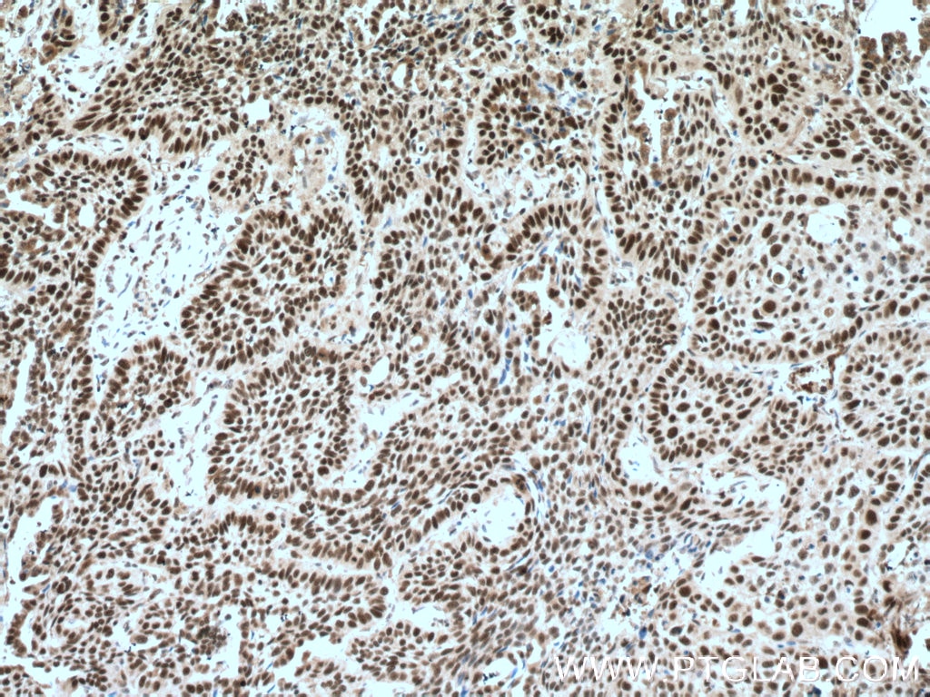 Immunohistochemistry (IHC) staining of human lung cancer tissue using PARP1 Polyclonal antibody (22999-1-AP)