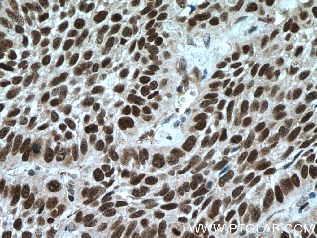 IHC staining of human lung cancer using 22999-1-AP