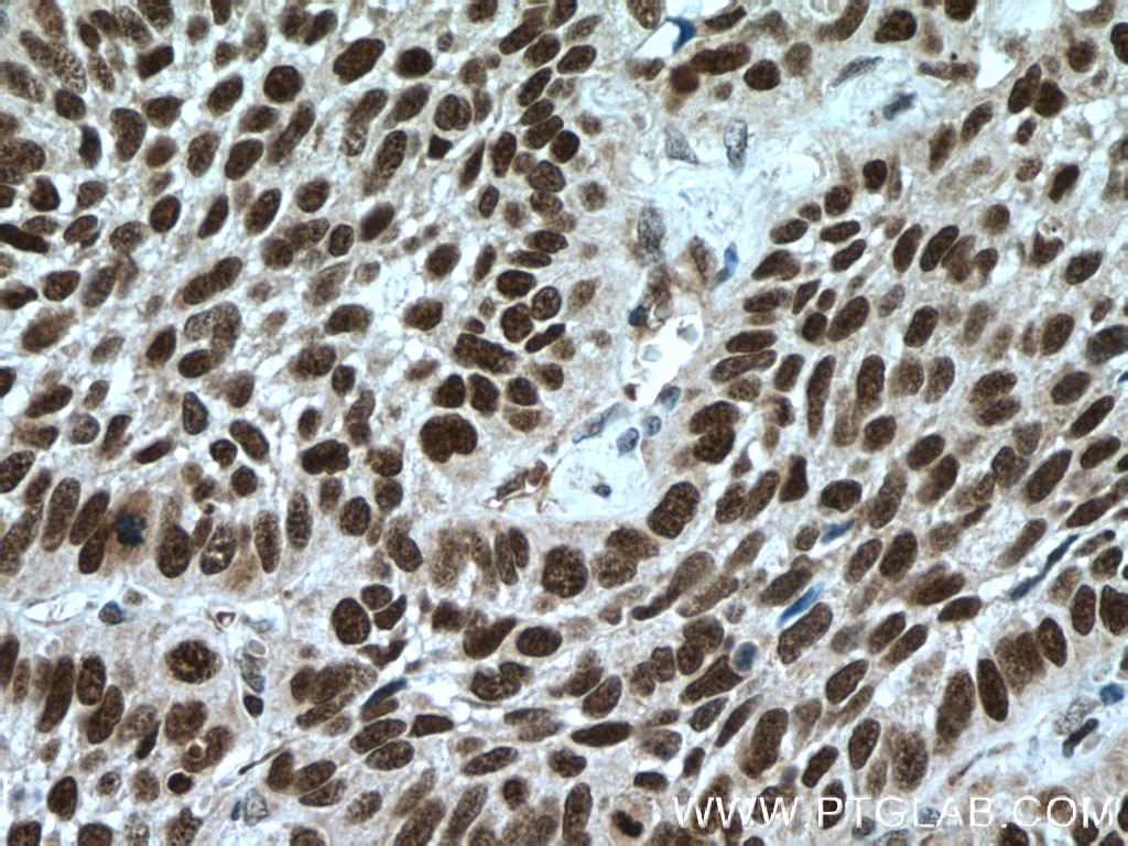 Immunohistochemistry (IHC) staining of human lung cancer tissue using PARP1 Polyclonal antibody (22999-1-AP)