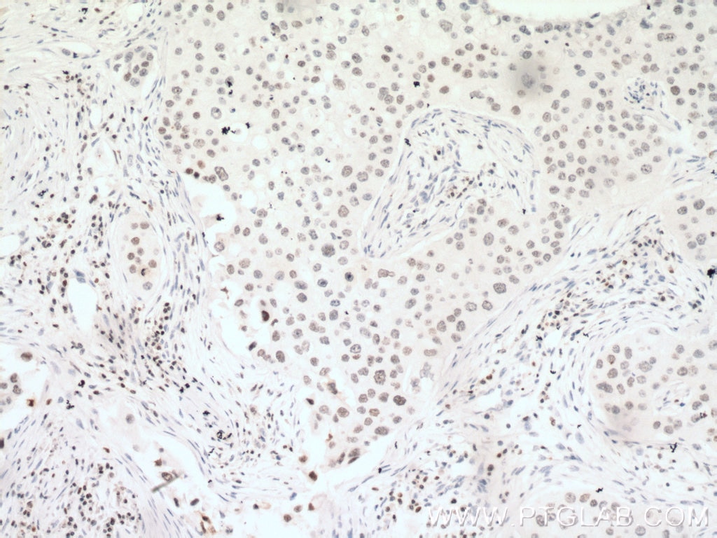 Immunohistochemistry (IHC) staining of human breast cancer tissue using PARP1 Monoclonal antibody (66520-1-Ig)