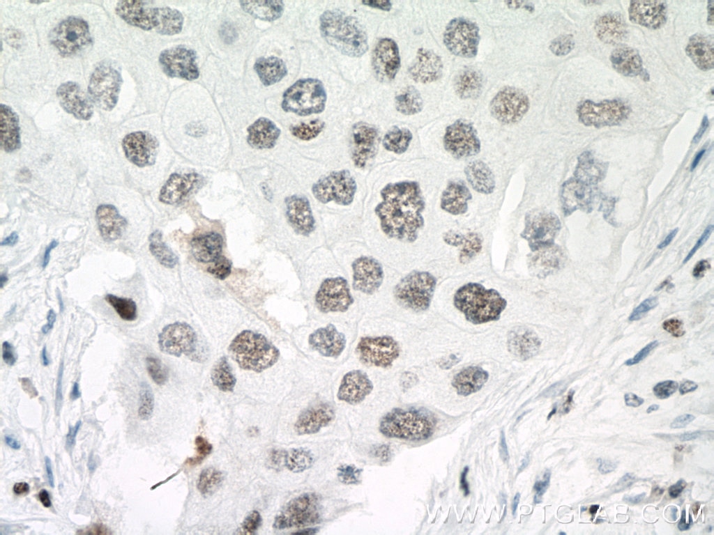 Immunohistochemistry (IHC) staining of human breast cancer tissue using PARP1 Monoclonal antibody (66520-1-Ig)