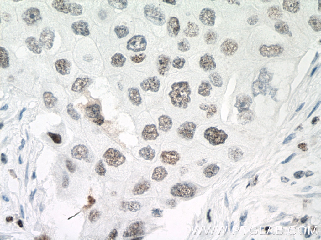 IHC staining of human breast cancer using 66520-1-Ig