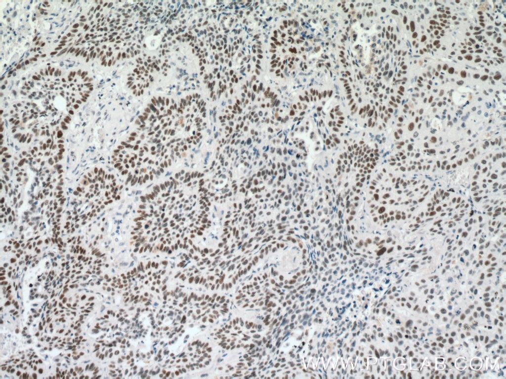 Immunohistochemistry (IHC) staining of human lung cancer tissue using PARP1 Monoclonal antibody (66520-1-Ig)
