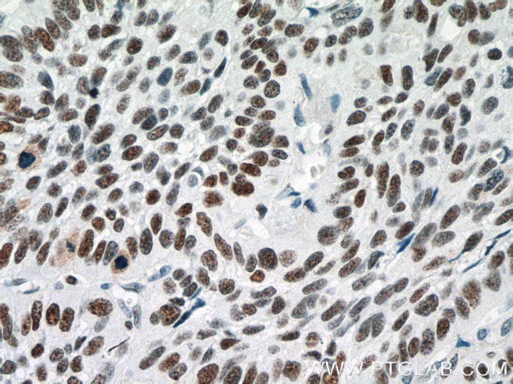 Immunohistochemistry (IHC) staining of human lung cancer tissue using PARP1 Monoclonal antibody (66520-1-Ig)