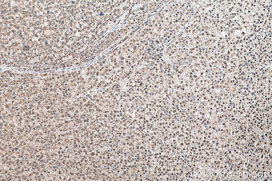IHC staining of human liver cancer using 80174-1-RR