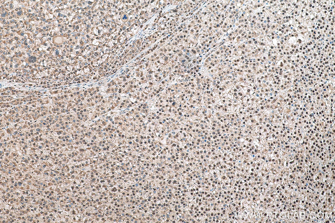 Immunohistochemistry (IHC) staining of human liver cancer tissue using PARP1 Recombinant antibody (80174-1-RR)