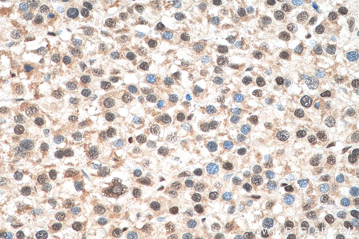 Immunohistochemistry (IHC) staining of human liver cancer tissue using PARP1 Recombinant antibody (80174-1-RR)