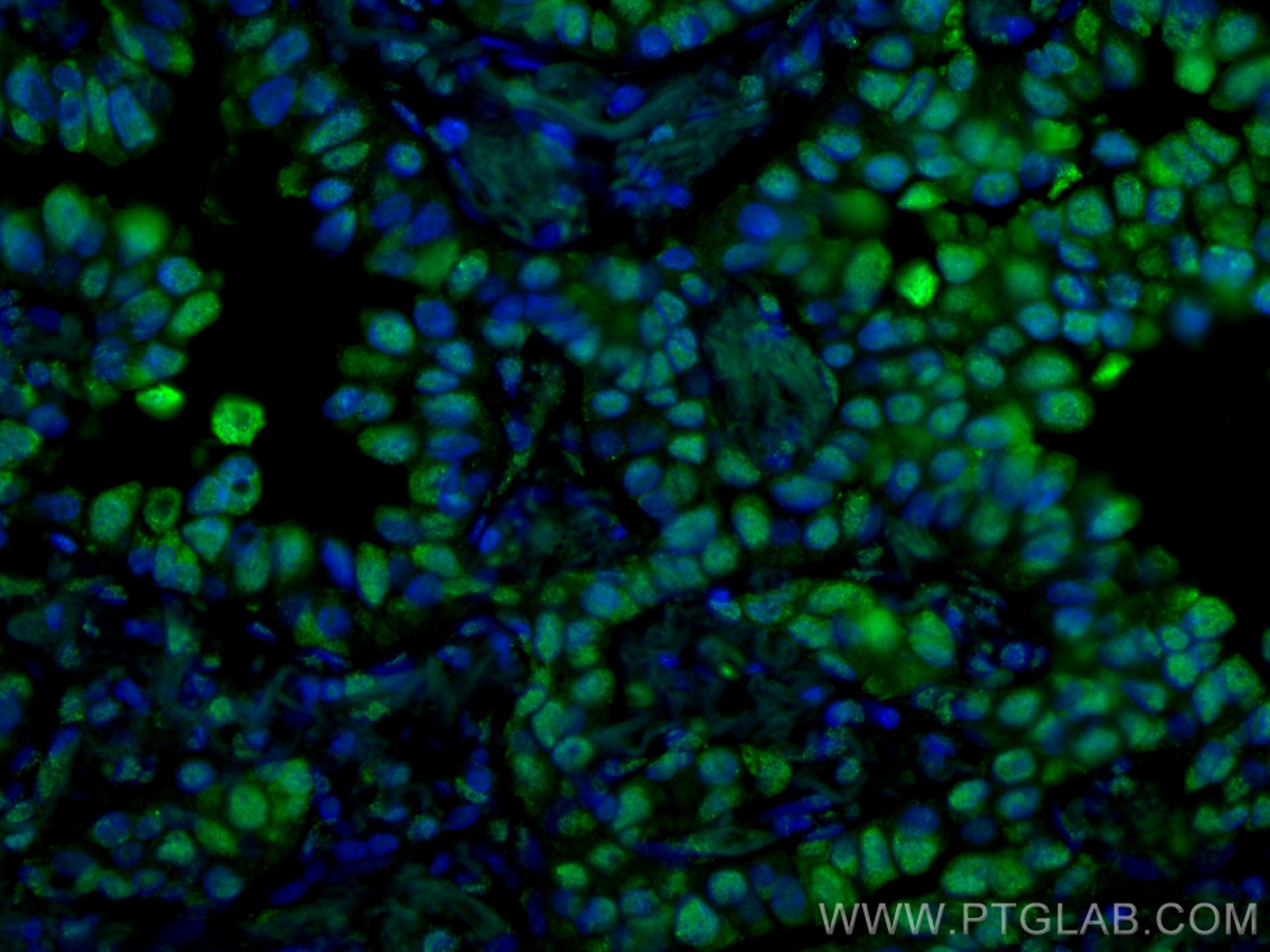 Immunofluorescence (IF) / fluorescent staining of human lung cancer tissue using CoraLite®488-conjugated PARP1 Monoclonal antibody (CL488-66520)