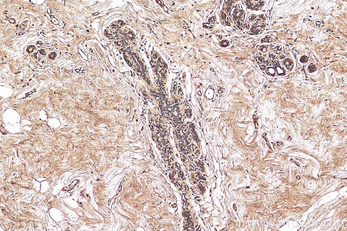 Immunohistochemistry (IHC) staining of human breast cancer tissue using PARP3 Polyclonal antibody (11289-1-AP)