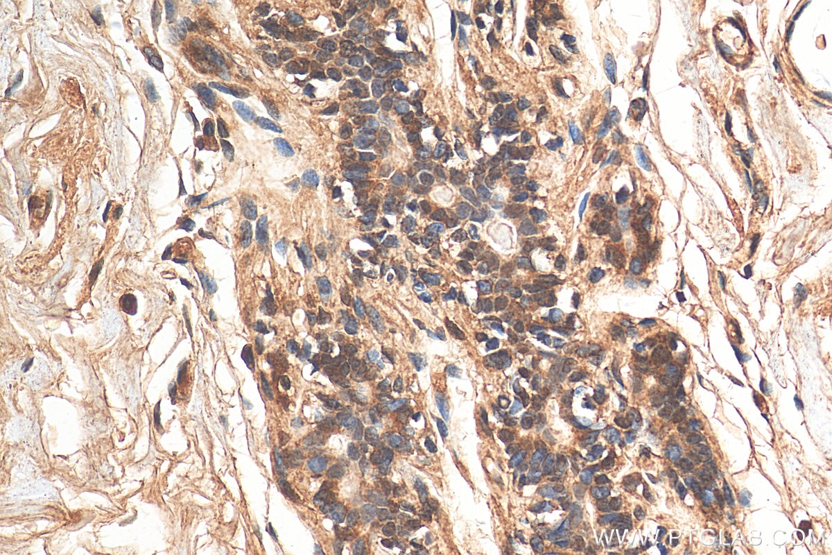 Immunohistochemistry (IHC) staining of human breast cancer tissue using PARP3 Polyclonal antibody (11289-1-AP)