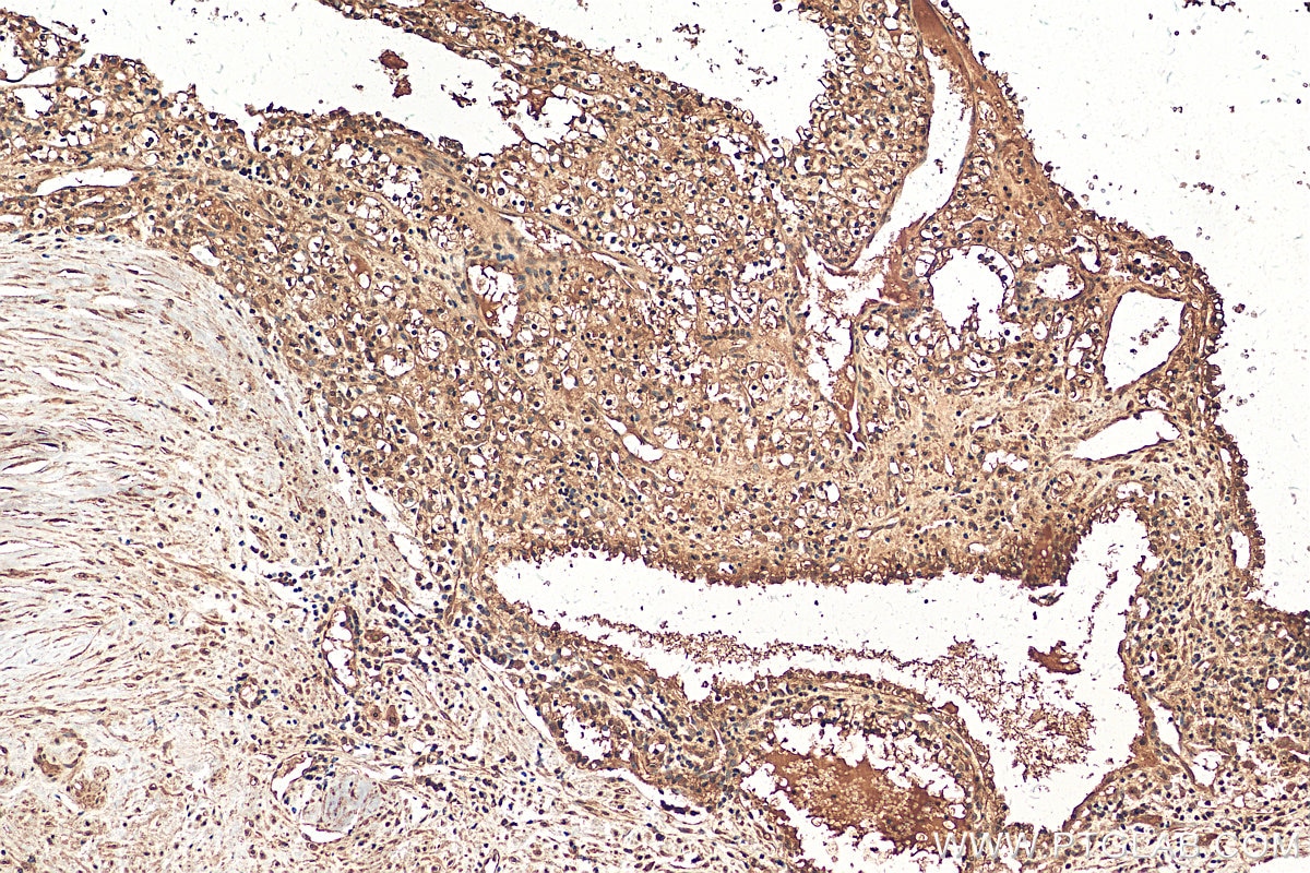 Immunohistochemistry (IHC) staining of human renal cell carcinoma tissue using PARP3 Polyclonal antibody (11289-1-AP)