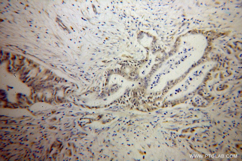 Immunohistochemistry (IHC) staining of human pancreas cancer tissue using PARP3 Polyclonal antibody (11289-1-AP)