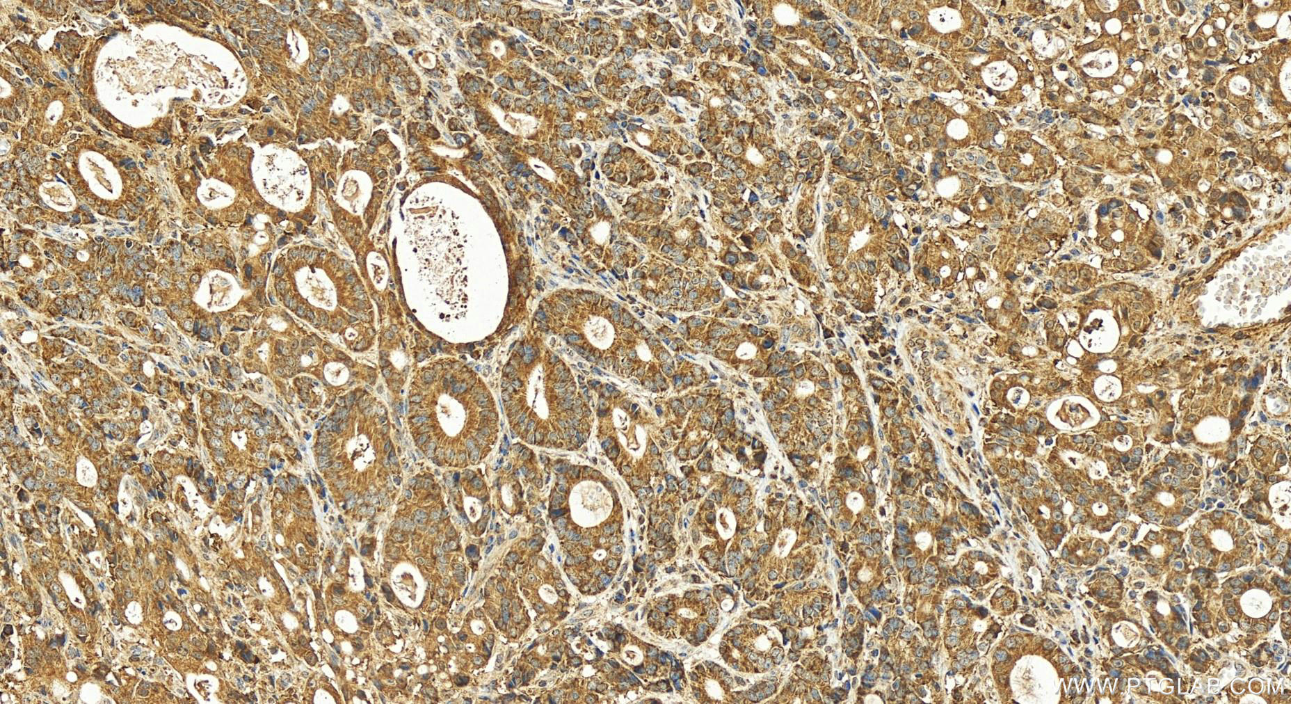 Immunohistochemistry (IHC) staining of human stomach cancer tissue using PARP4 Polyclonal antibody (19775-1-AP)