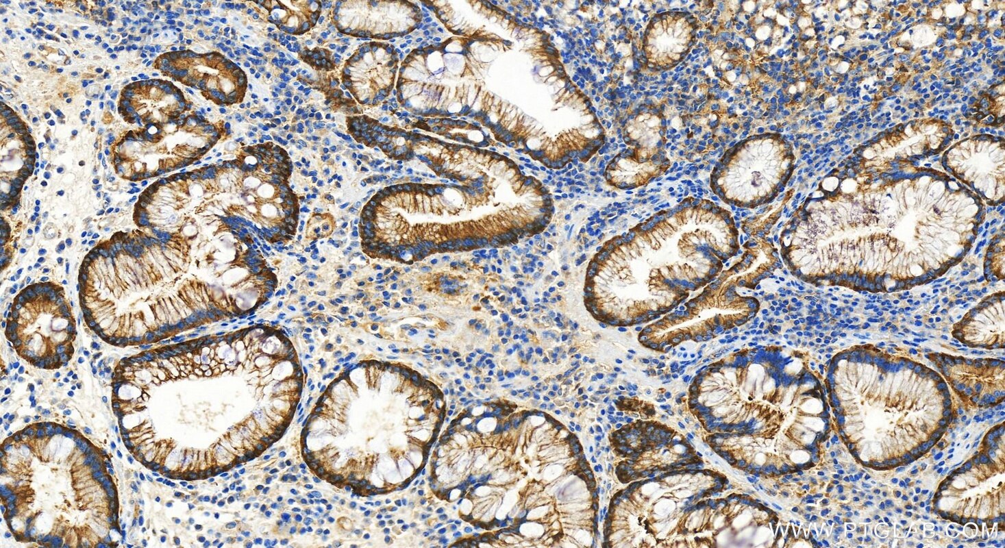 Immunohistochemistry (IHC) staining of human stomach cancer tissue using PARP4 Recombinant antibody (84001-1-RR)