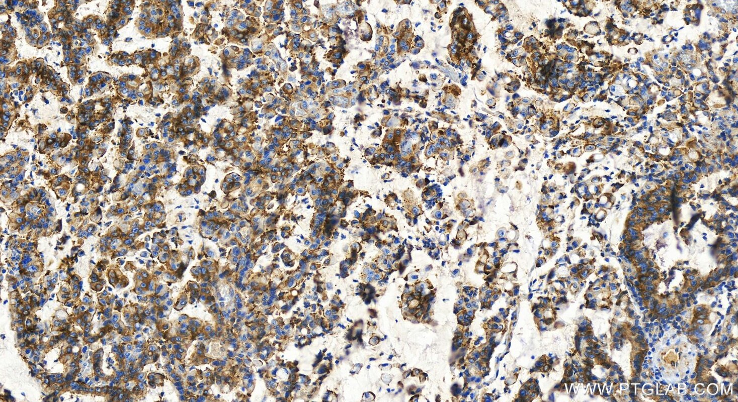 Immunohistochemistry (IHC) staining of human stomach cancer tissue using PARP4 Recombinant antibody (84001-1-RR)