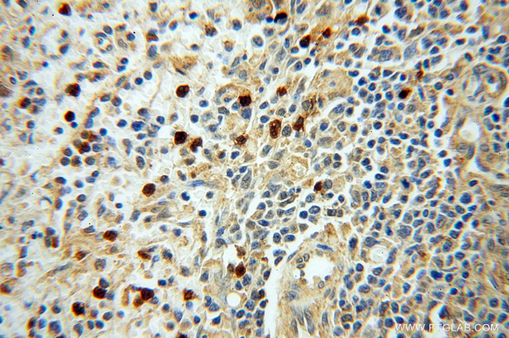 Immunohistochemistry (IHC) staining of human spleen tissue using PARP9 Polyclonal antibody (17535-1-AP)