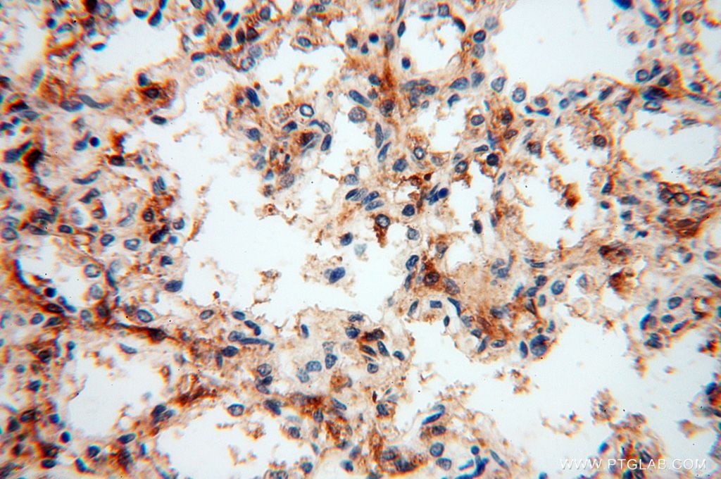 Immunohistochemistry (IHC) staining of human lung tissue using PARP9 Polyclonal antibody (17535-1-AP)