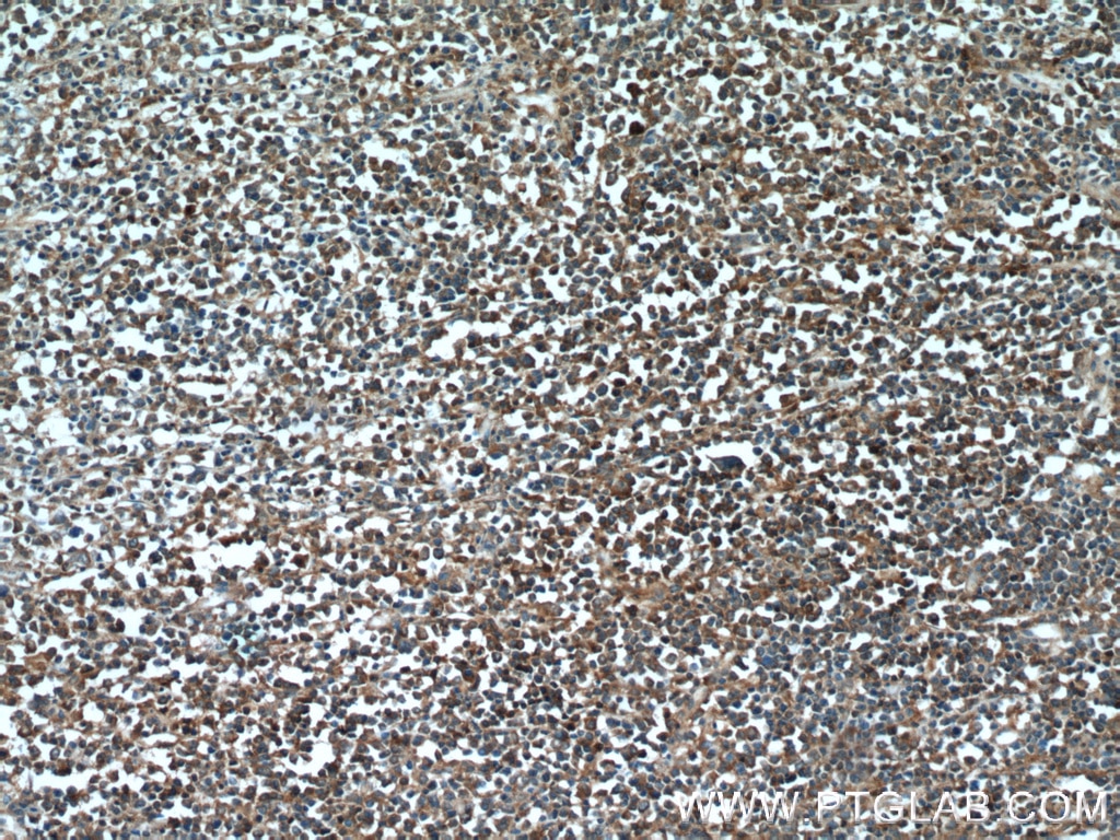 Immunohistochemistry (IHC) staining of human lymphoma tissue using PARP9 Polyclonal antibody (17535-1-AP)