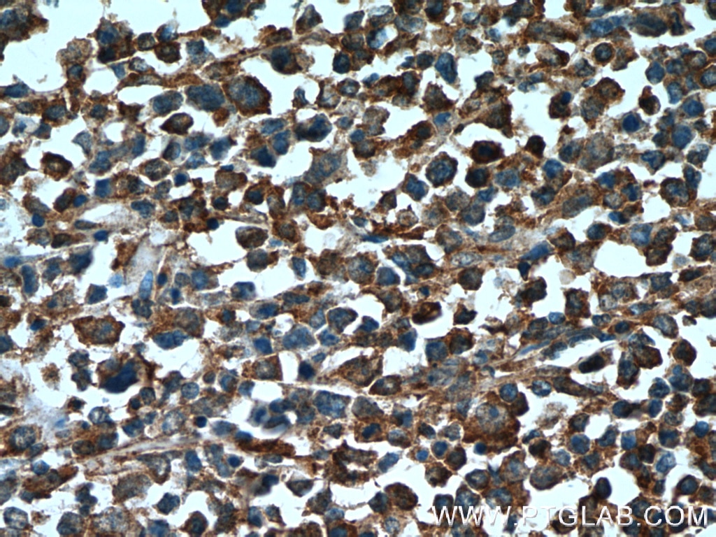 IHC staining of human lymphoma using 17535-1-AP