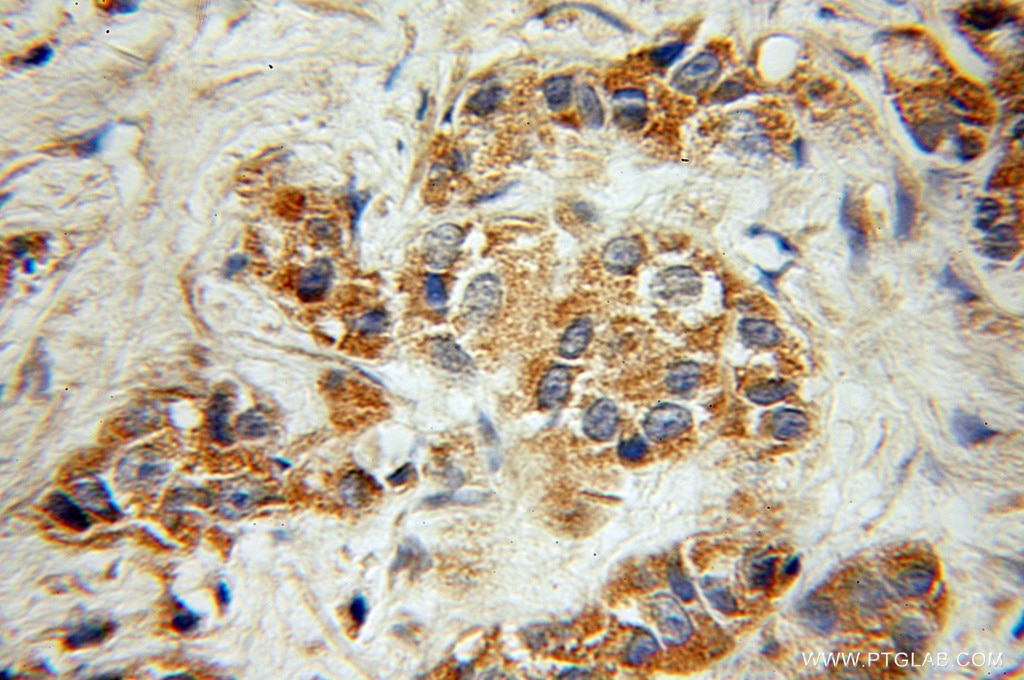 Immunohistochemistry (IHC) staining of human prostate cancer tissue using Alpha Parvin/Actopaxin Polyclonal antibody (11202-1-AP)
