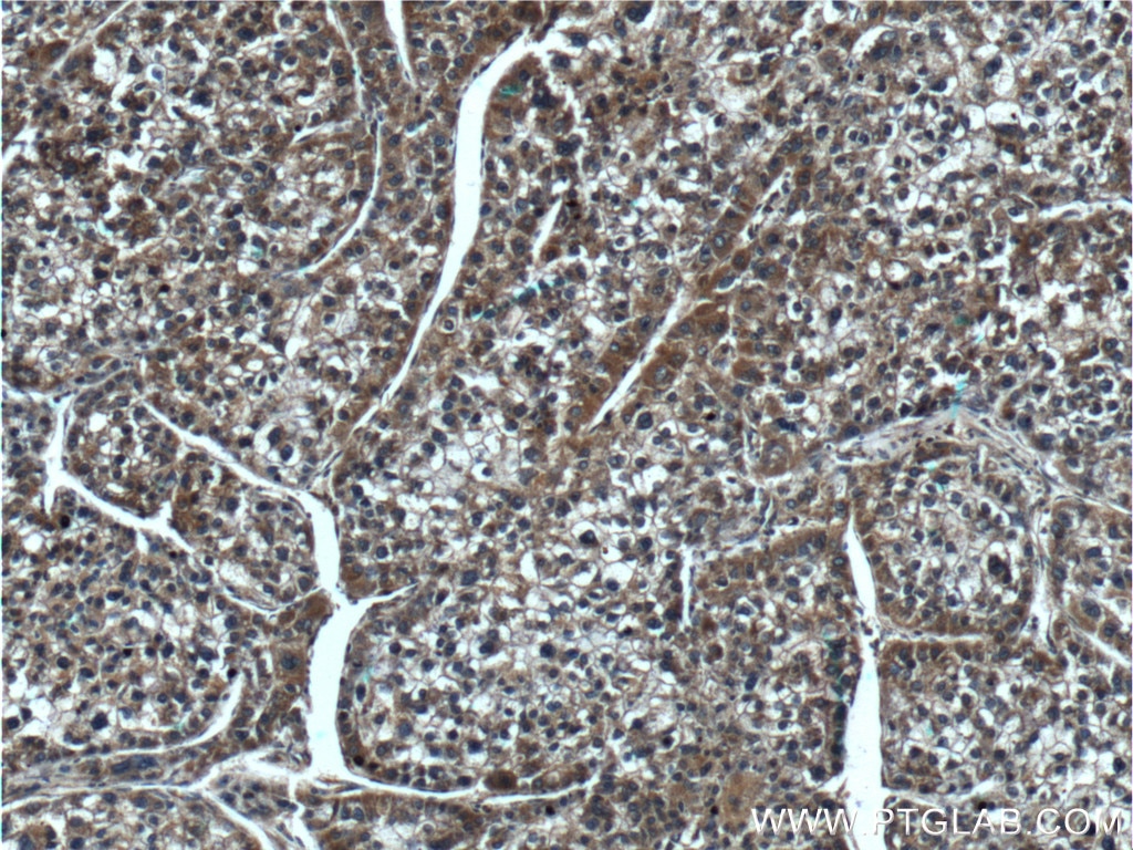 IHC staining of human liver cancer using 55268-1-AP