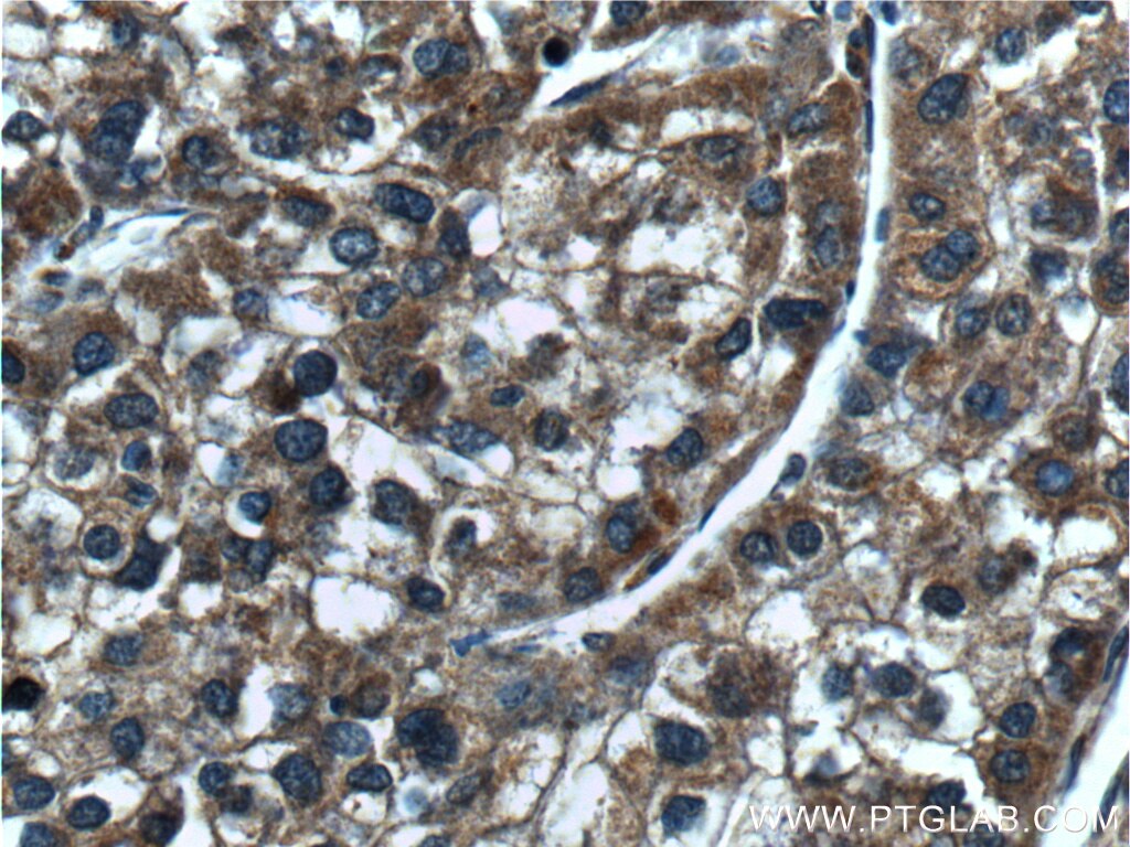 Immunohistochemistry (IHC) staining of human liver cancer tissue using Alpha Parvin/Actopaxin Polyclonal antibody (55268-1-AP)