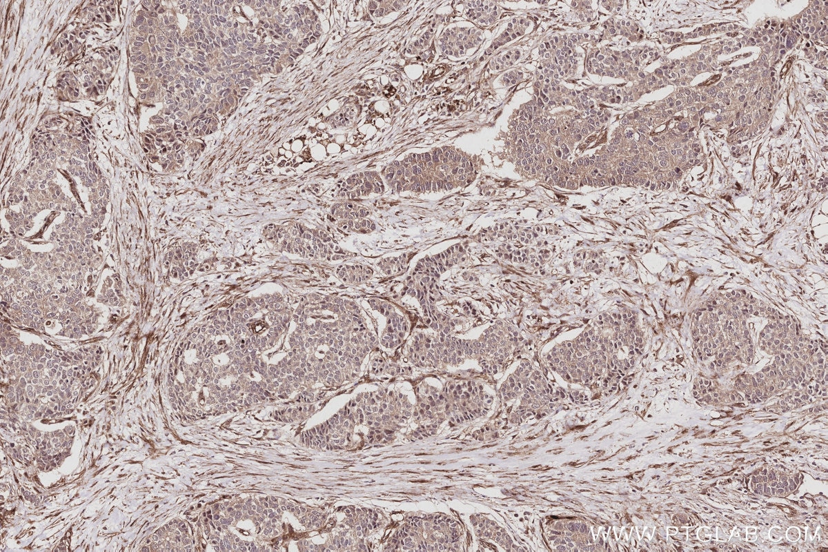 Immunohistochemistry (IHC) staining of human stomach cancer tissue using PARVB Recombinant monoclonal antibody (85711-1-RR)