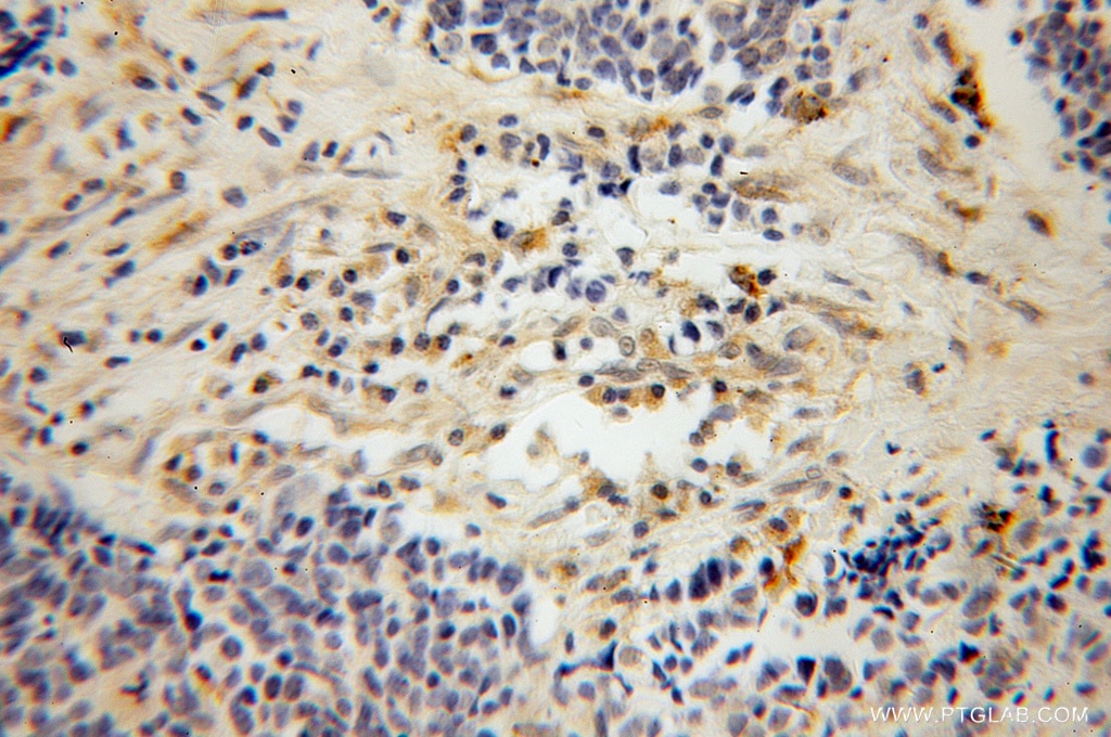 Immunohistochemistry (IHC) staining of human lung cancer tissue using PARVG Polyclonal antibody (13284-1-AP)