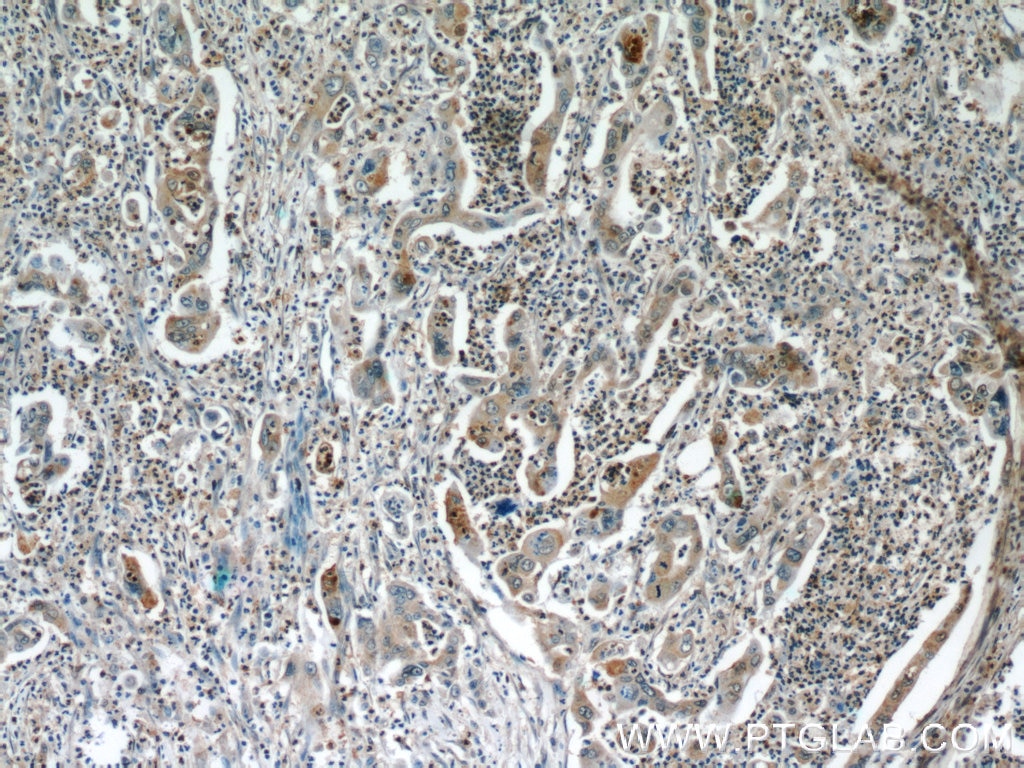 IHC staining of human pancreas cancer using 12600-1-AP