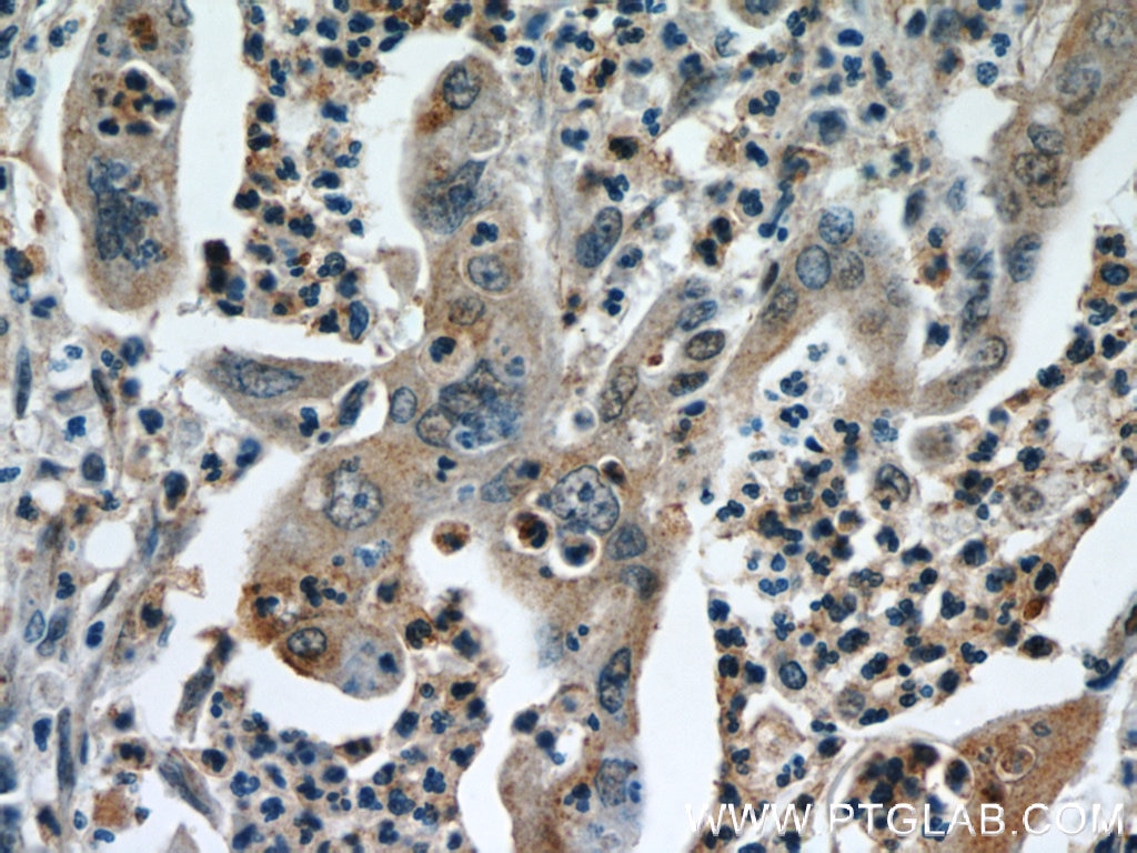 Immunohistochemistry (IHC) staining of human pancreas cancer tissue using CPB1 Polyclonal antibody (12600-1-AP)