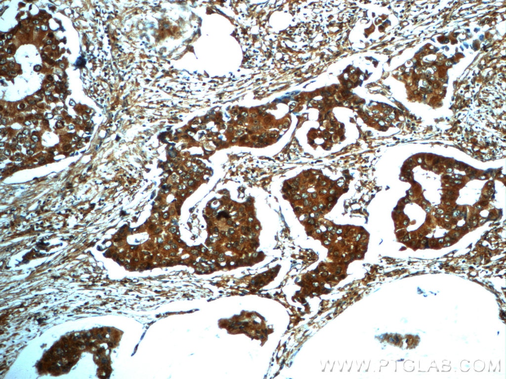 Immunohistochemistry (IHC) staining of human breast cancer tissue using PAWR Polyclonal antibody (20688-1-AP)