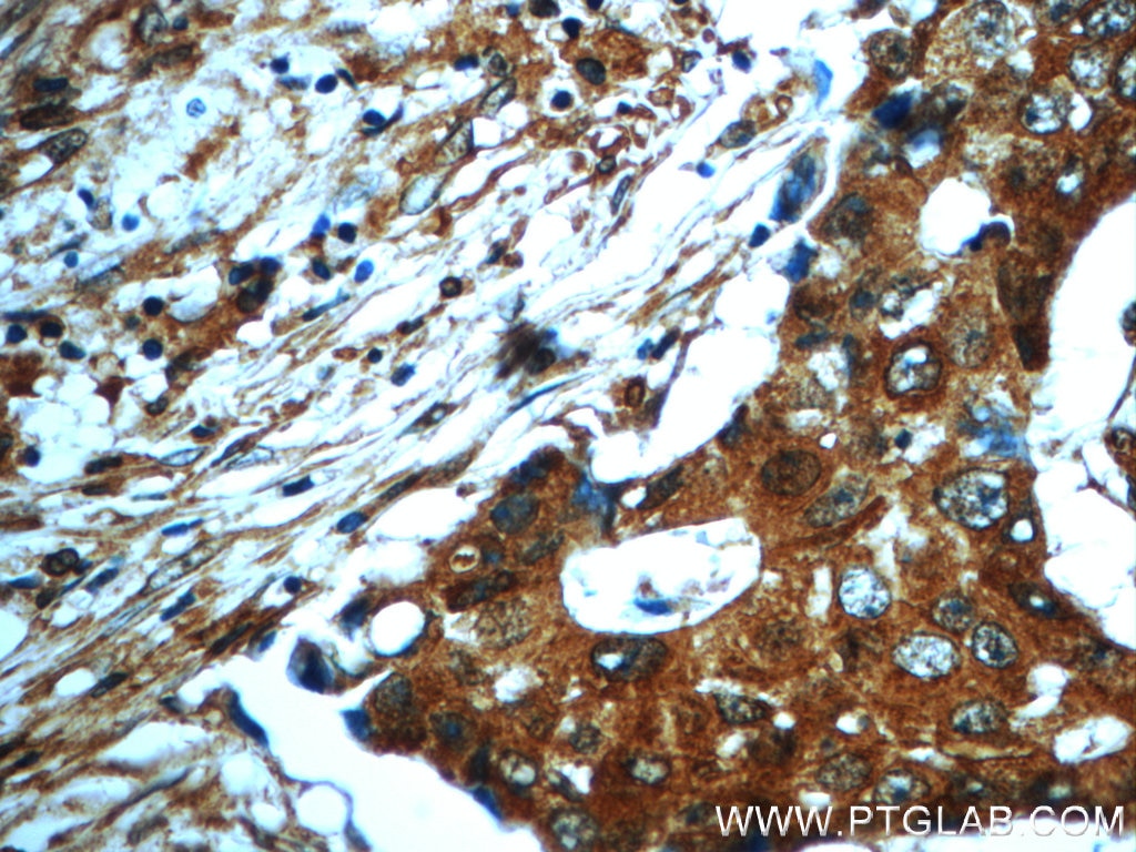 IHC staining of human breast cancer using 20688-1-AP