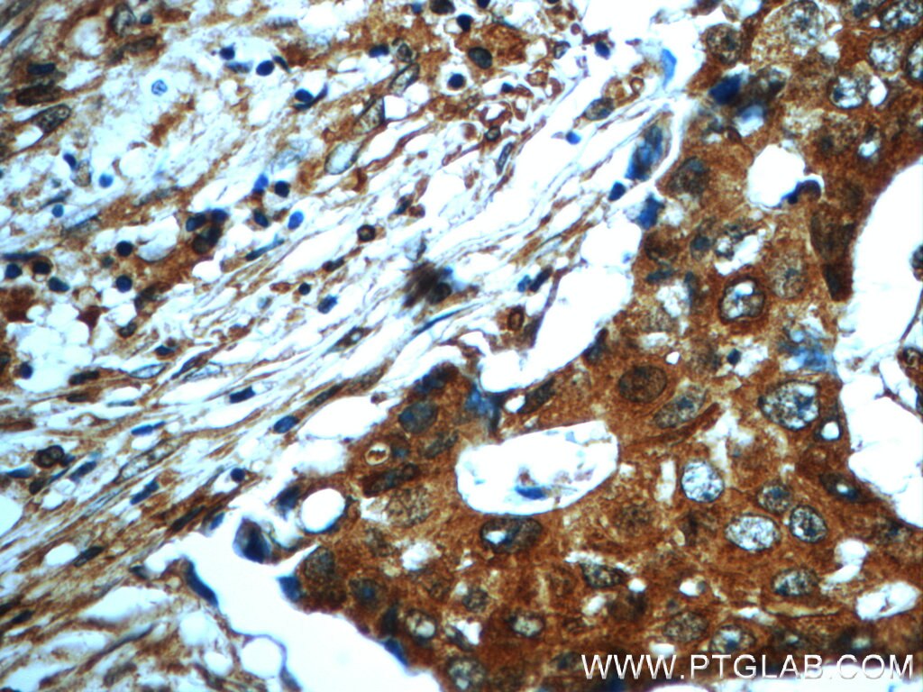 Immunohistochemistry (IHC) staining of human breast cancer tissue using PAWR Polyclonal antibody (20688-1-AP)