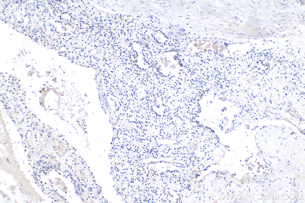 Immunohistochemistry (IHC) staining of human renal cell carcinoma tissue using PAX2 Polyclonal antibody (29307-1-AP)