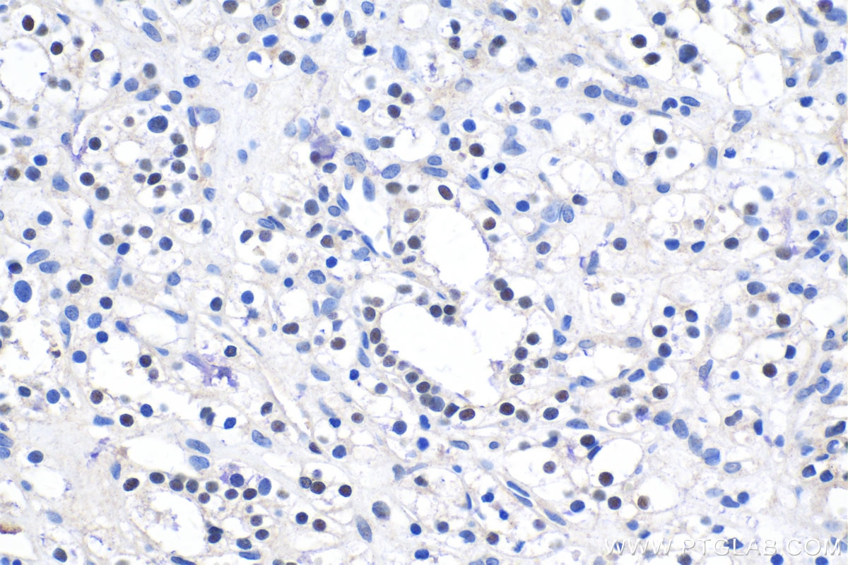 Immunohistochemistry (IHC) staining of human renal cell carcinoma tissue using PAX2 Polyclonal antibody (29307-1-AP)