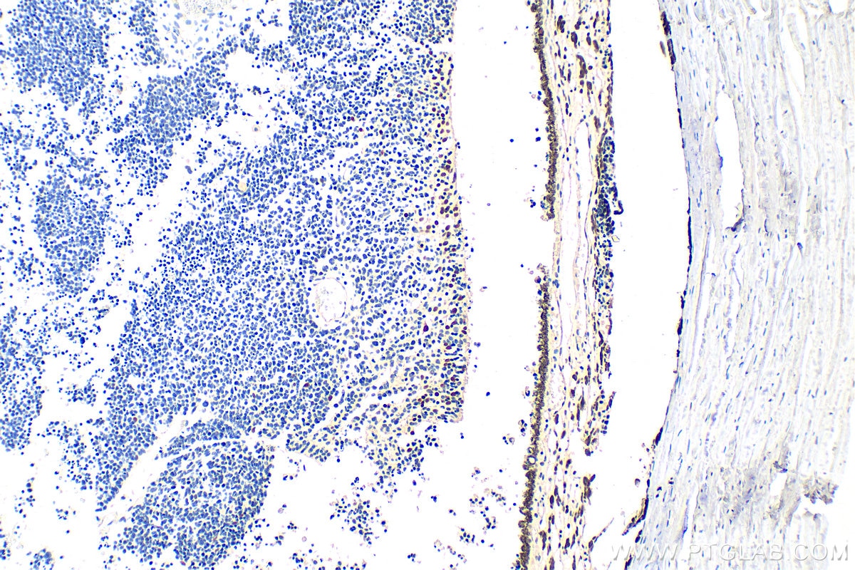 Immunohistochemistry (IHC) staining of human retinoblastoma tissue using PAX6 Polyclonal antibody (12323-1-AP)