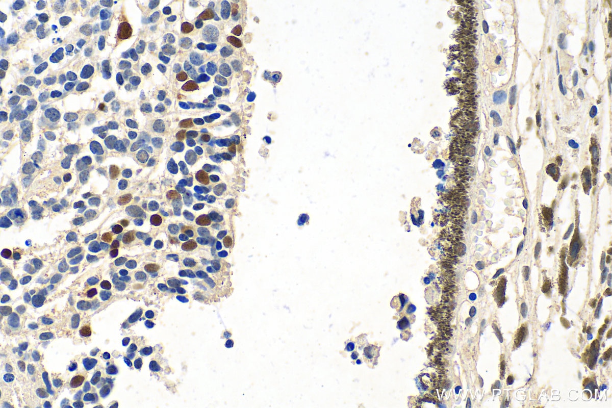 Immunohistochemistry (IHC) staining of human retinoblastoma tissue using PAX6 Polyclonal antibody (12323-1-AP)