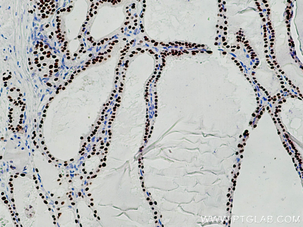Immunohistochemistry (IHC) staining of human thyroid cancer tissue using PAX8 Polyclonal antibody (10336-1-AP)