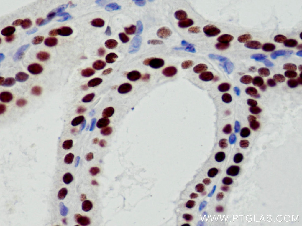 IHC staining of human thyroid cancer using 10336-1-AP