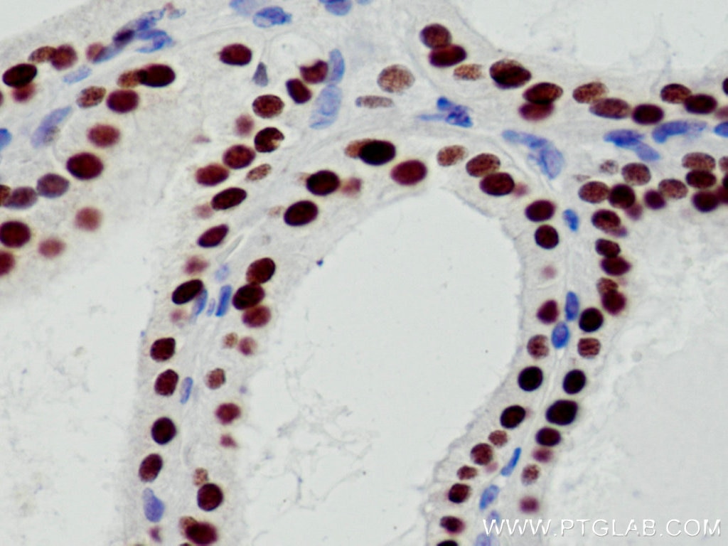 Immunohistochemistry (IHC) staining of human thyroid cancer tissue using PAX8 Polyclonal antibody (10336-1-AP)