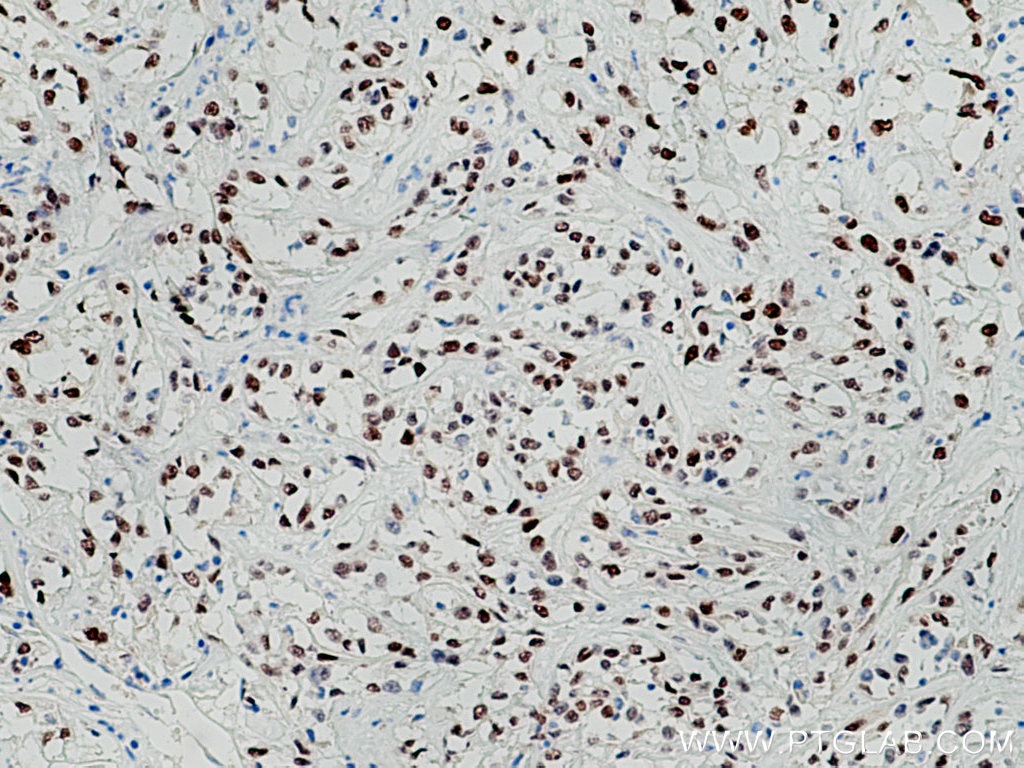 IHC staining of human renal cell carcinoma using 10336-1-AP
